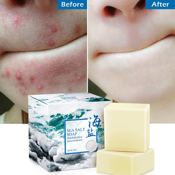 Sea Salt Soap Removal Pimple Pores